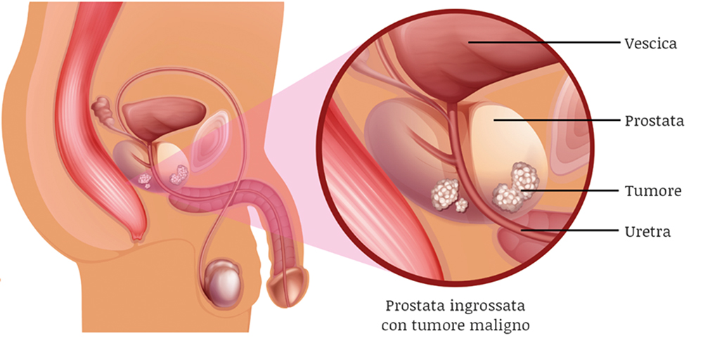 Disegno tecnico di una prostata ingrossata con tumore maligno
